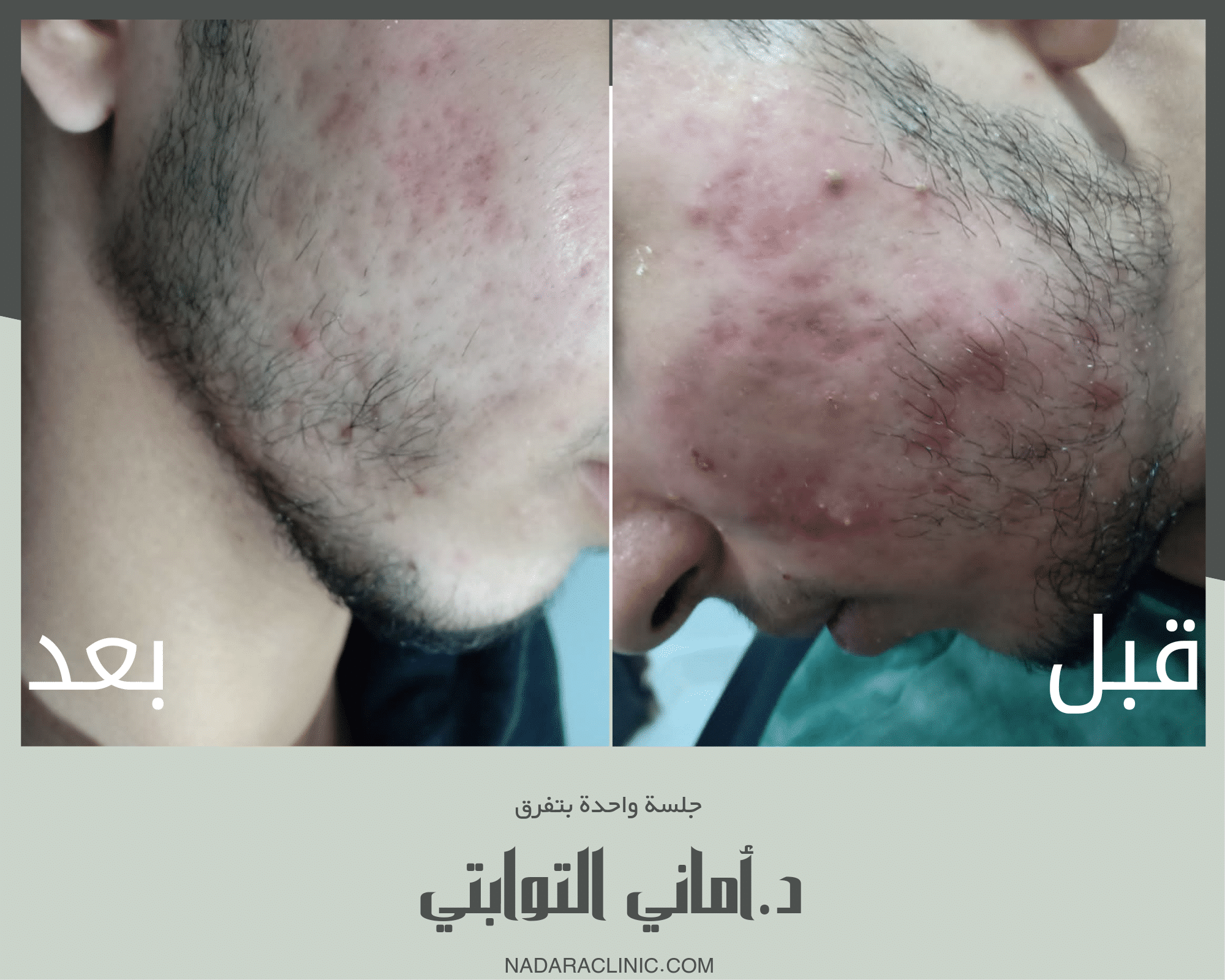 قبل و بعد علاج حبوب الشباب الشديدة